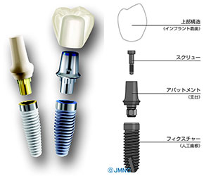 インプラントは３つのパーツに分かれています