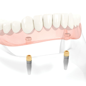 入れ歯を固定するためのインプラントオーバーデンチャー